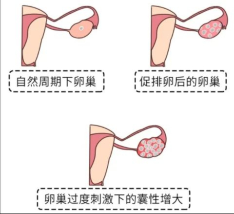 哪些情况需要进行解冻胚胎移植呢？