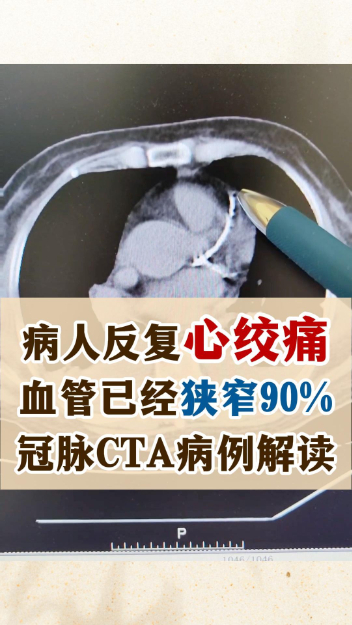 冠脉CTA案例解读，病人血管狭窄90%【官方编号：1288752238317568】