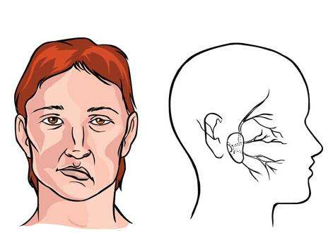 难治性面瘫知多少